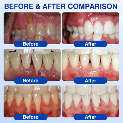 🦷 US Official Store | PuraCure® Tooth & Gum Oral Repair Solution | Powered by Bee Venom Peptides × Collagen × Postbiotics × Beta-Glucanase to Fight Plaque, Tartar, Tooth Pain, Bad Breath & Weak Teeth