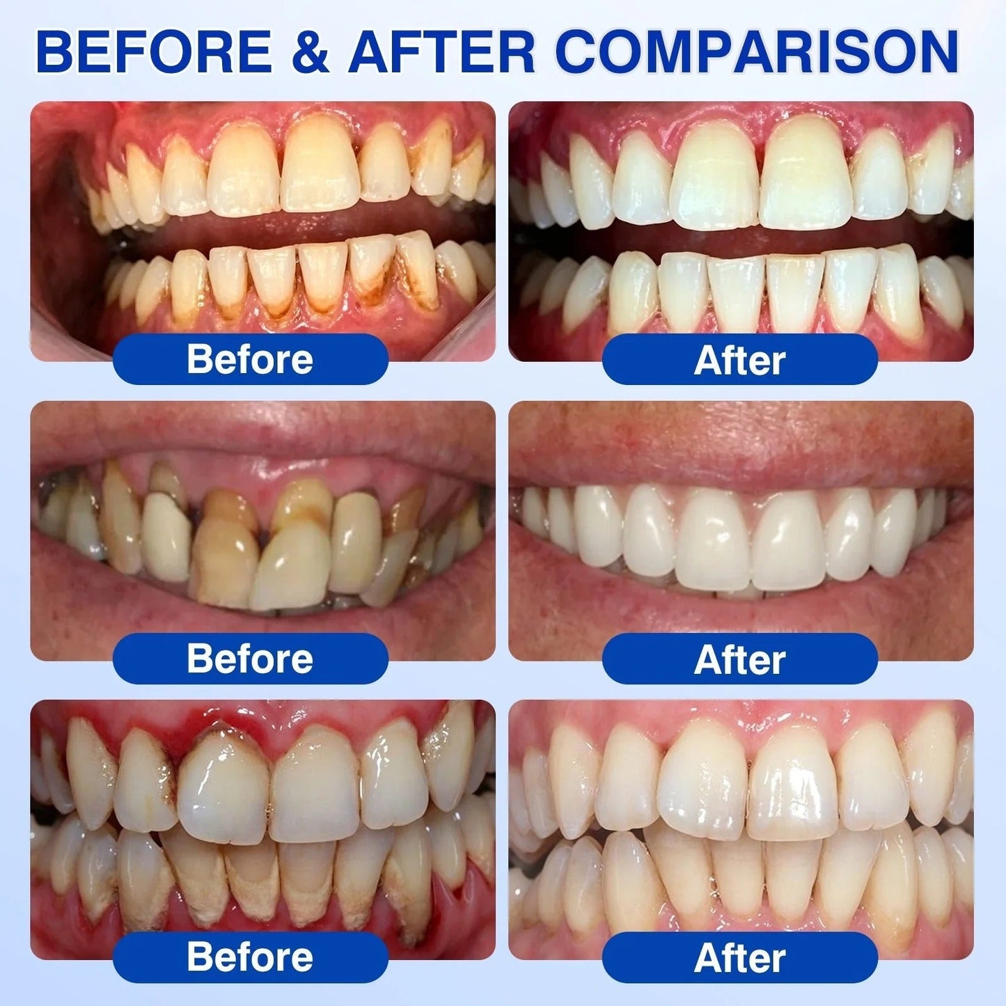 🦷 US Official Store | PuraCure® Tooth & Gum Oral Repair Solution | Powered by Bee Venom Peptides × Collagen × Postbiotics × Beta-Glucanase to Fight Plaque, Tartar, Tooth Pain, Bad Breath & Weak Teeth